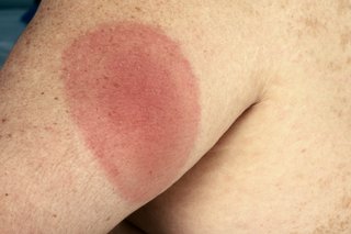 A circular red Lyme disease rash on an arm.