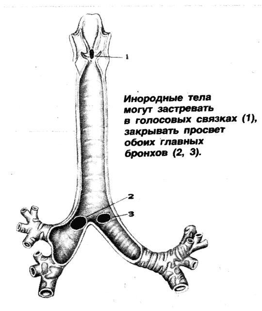 инородное тело в глотке