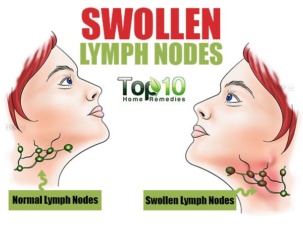 Normal vs. Swollen Lymph Node